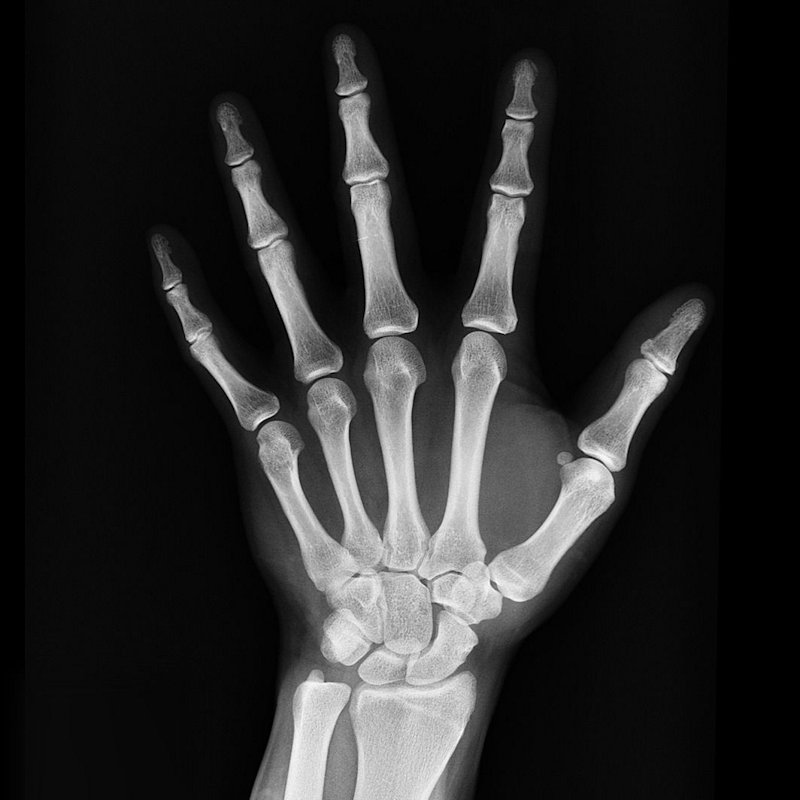 x-ray, medical treatment, arm